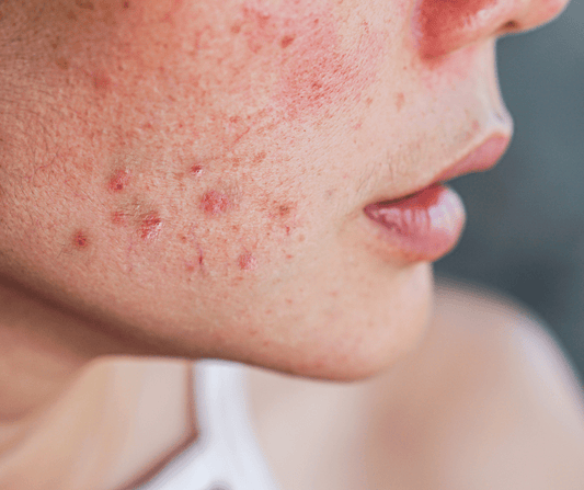 Los Mejores Ingredientes Japoneses para Piel Sensible - KOEN JAPAN BEAUTY